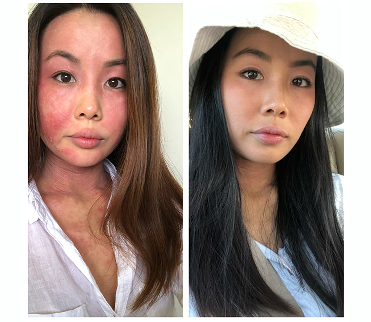 How I Was Affected By Topical Steroid Withdrawal (TSW), Protopic (tacrolimus) and Prednisolone (oral steroid).